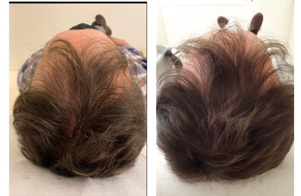 Alopecia mesoterapia Dutasteride Dr. Victoriano Morales dermatologo en Madrid